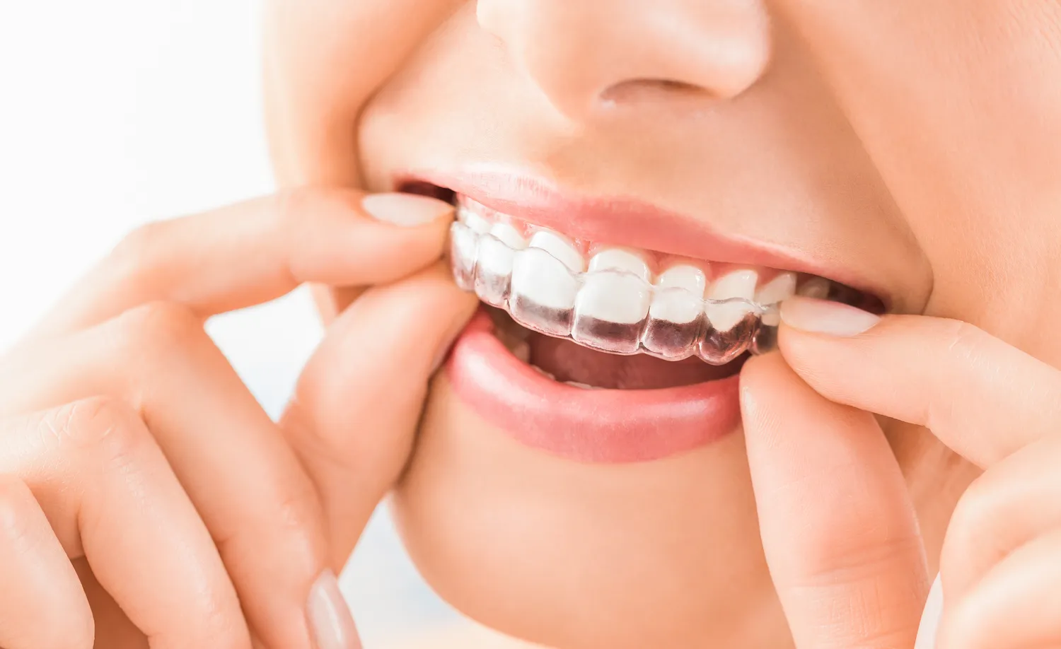 Aparat nakładkowy Invisalign Warszawa